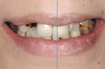 正中線と歯並びのバランス