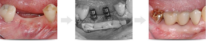 歯肉移植手術で見た目を改善